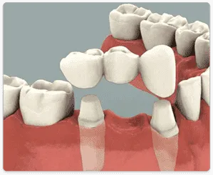 Bridge Dental in Chennai