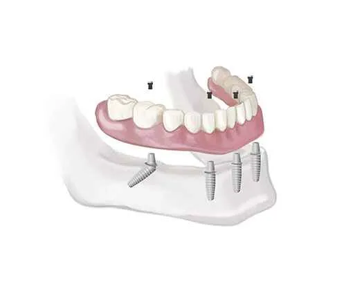 Full Mouth Dentures in Chennai