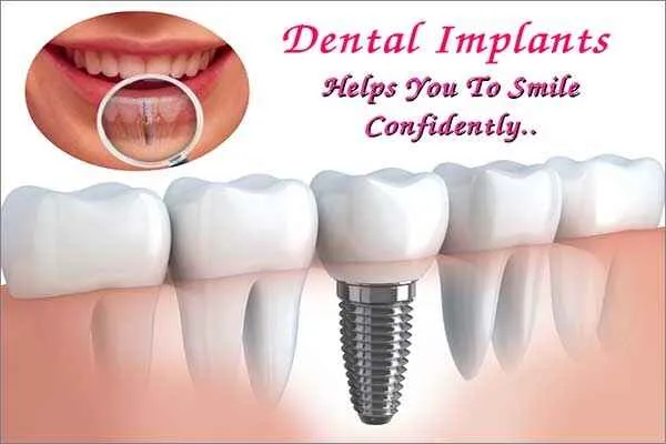 Dental Implants in Chennai