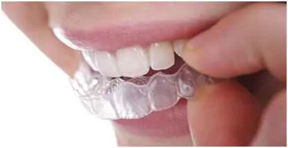 Invisible Braces in Chennai