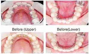 Ceramic and Lingual Braces in Chennai