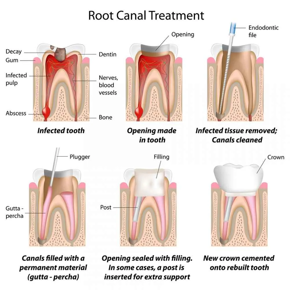 Root Canal Therapy in Chennai