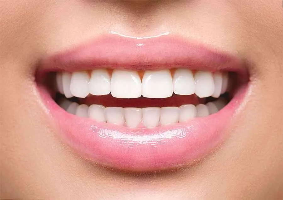 Tooth Whitening in Chennai